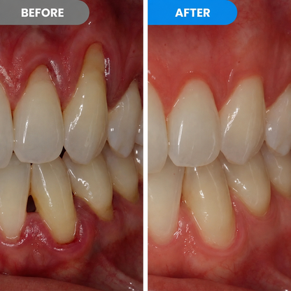 Teeth Repair Pen
